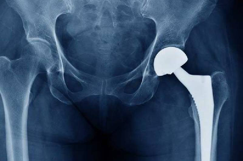 hip replacement in Dhayari